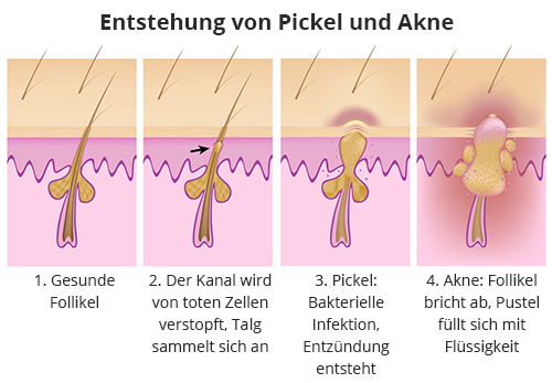 Entstehung von Pickel und Akne