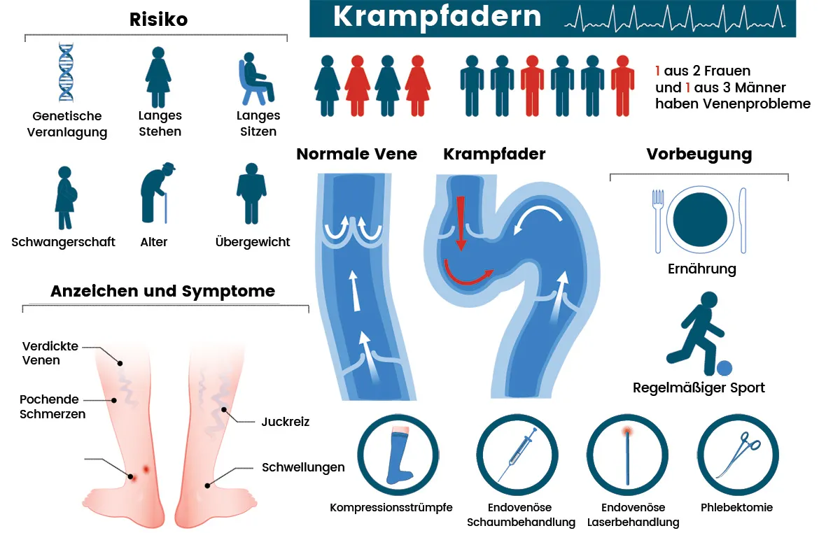 Krampfadern-Infografik