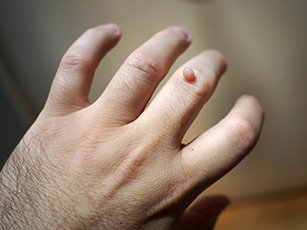 Warze am Finger Warze am Finger