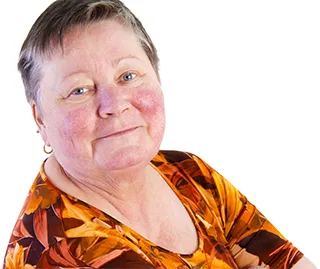 Rosacea Rosacea