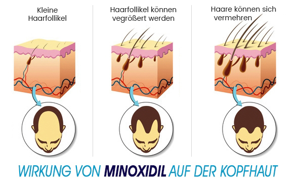 Minoxidil Anwendung