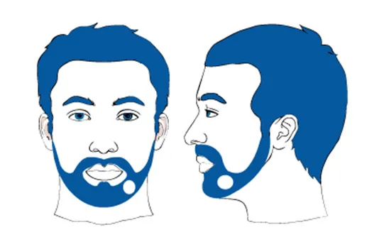 Sogar am Bart kann man Haarausfall haben