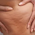 Cellulite reduzieren mit Dermaroller