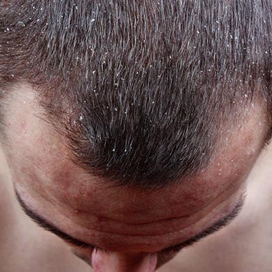 Wie kann Haarausfall bekämpft werden?