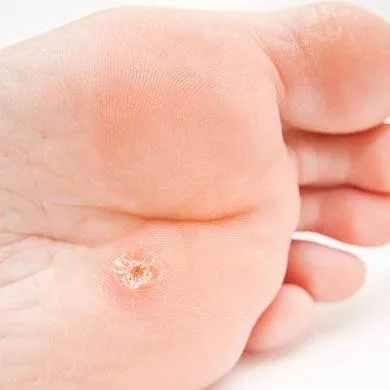 Dermisil Nail Infection - Anwendung