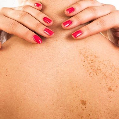 Impfung gegen HPV