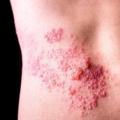HPV-Virus