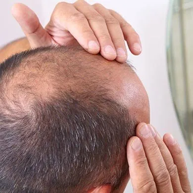 Wie sollte Minoxidil verwendet werden?