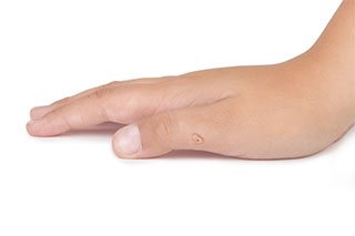 Warze am Finger Warze am Finger