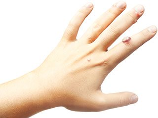 Warze auf der Hand Warze auf der Hand