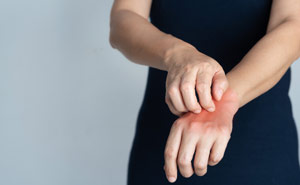 Scabies on Hands Scabies on Hands