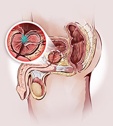 cáncer de próstata metástasis síntomas