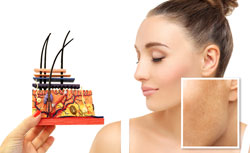 Hyperpigmentation bei einer Frau Hyperpigmentation bei einer Frau