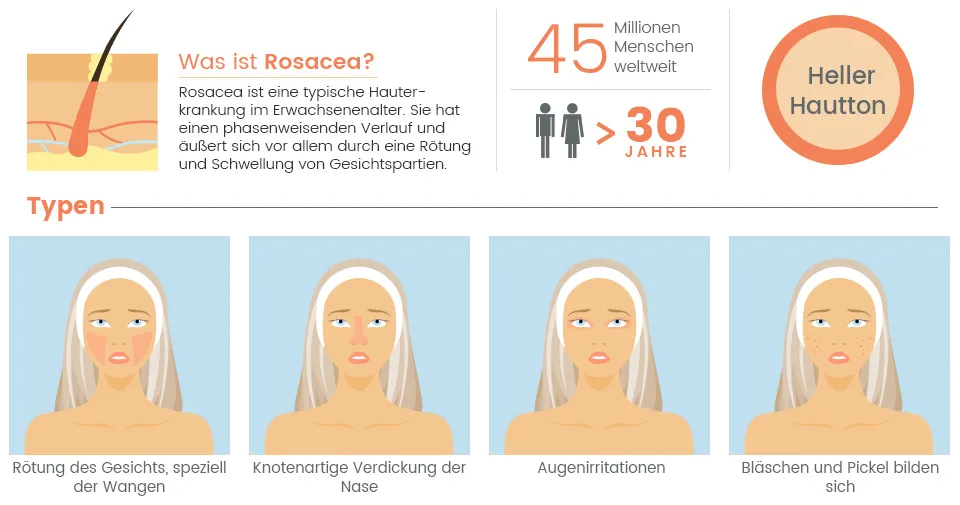 Infografik Rosacea